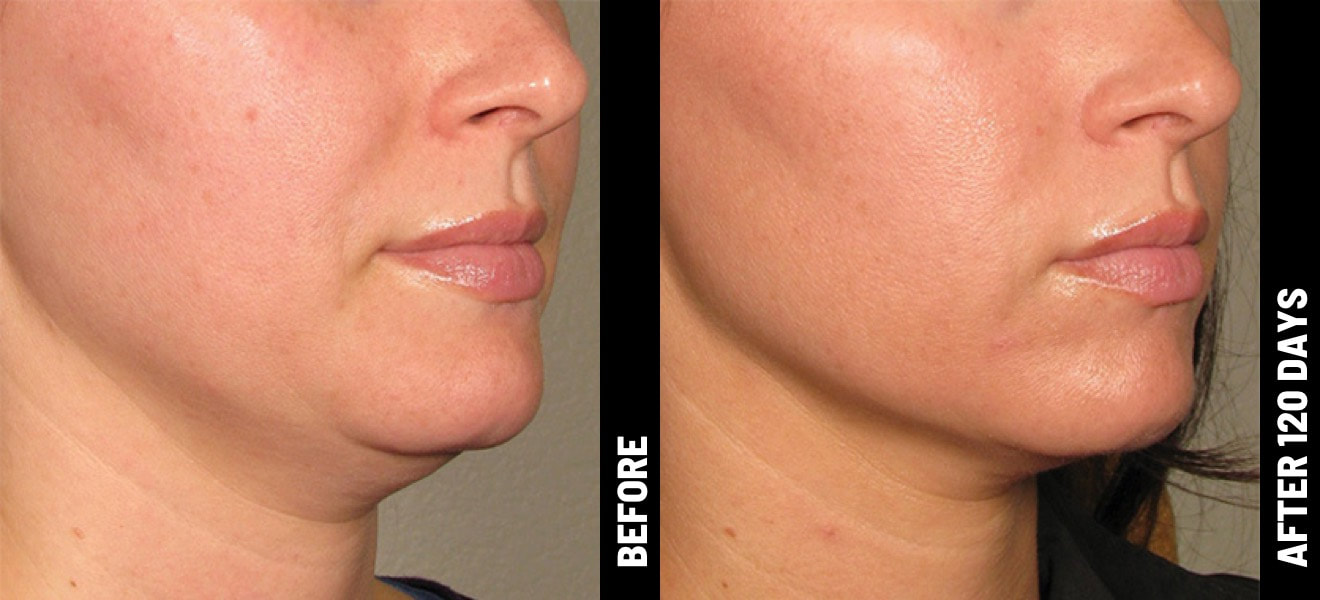 Ultherapy® uses microfocused ultrasound to generate a thermal effect under the skin. 